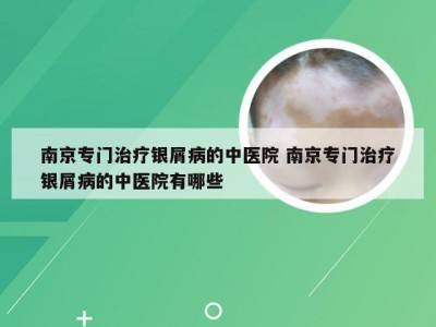 南京专门治疗银屑病的中医院 南京专门治疗银屑病的中医院有哪些