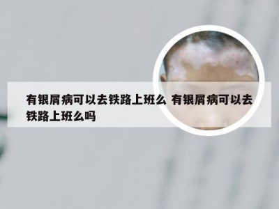 有银屑病可以去铁路上班么 有银屑病可以去铁路上班么吗