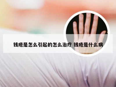 钱疮是怎么引起的怎么治疗 钱疮是什么病