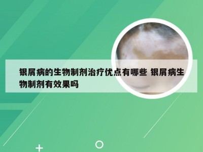 银屑病的生物制剂治疗优点有哪些 银屑病生物制剂有效果吗