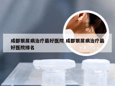 成都银屑病治疗最好医院 成都银屑病治疗最好医院排名