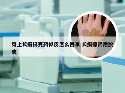 身上长癣抹完药掉皮怎么回事 长癣擦药后脱皮