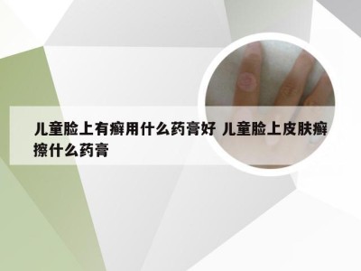 儿童脸上有癣用什么药膏好 儿童脸上皮肤癣擦什么药膏