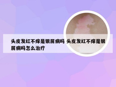 头皮发红不痒是银屑病吗 头皮发红不痒是银屑病吗怎么治疗