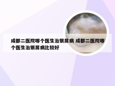 成都二医院哪个医生治银屑病 成都二医院哪个医生治银屑病比较好