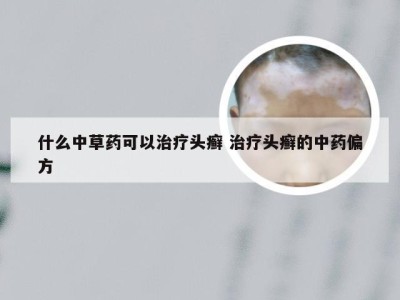 什么中草药可以治疗头癣 治疗头癣的中药偏方