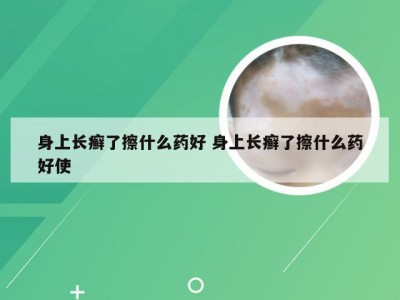 身上长癣了擦什么药好 身上长癣了擦什么药好使