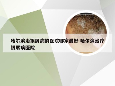 哈尔滨治银屑病的医院哪家最好 哈尔滨治疗银屑病医院