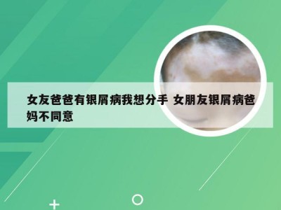 女友爸爸有银屑病我想分手 女朋友银屑病爸妈不同意