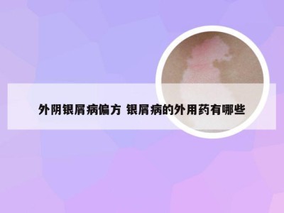 外阴银屑病偏方 银屑病的外用药有哪些