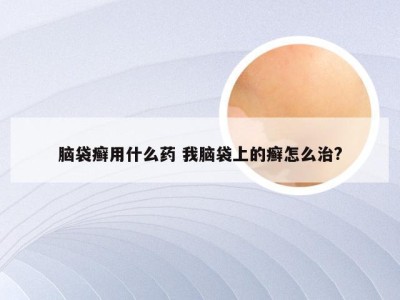 脑袋癣用什么药 我脑袋上的癣怎么治?