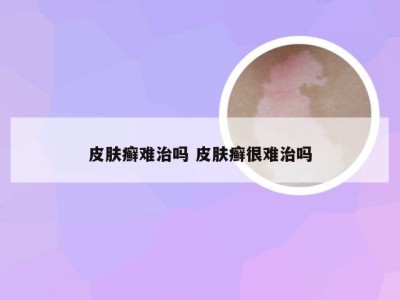 皮肤癣难治吗 皮肤癣很难治吗