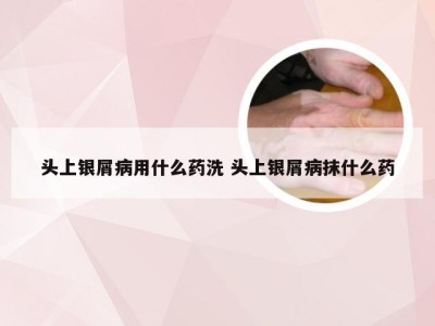 头上银屑病用什么药洗 头上银屑病抹什么药