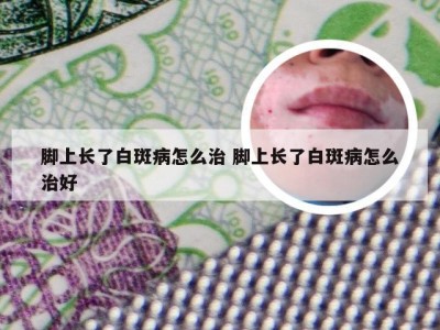 脚上长了白斑病怎么治 脚上长了白斑病怎么治好