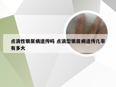 点滴性银屑病遗传吗 点滴型银屑病遗传几率有多大