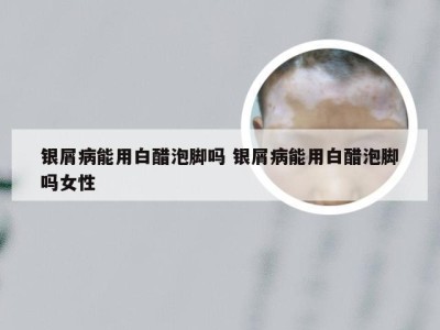 银屑病能用白醋泡脚吗 银屑病能用白醋泡脚吗女性