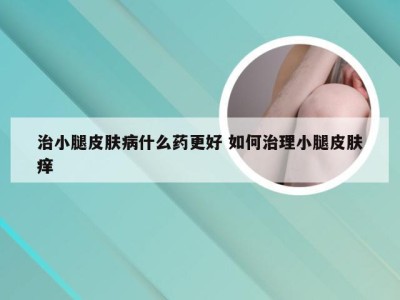 治小腿皮肤病什么药更好 如何治理小腿皮肤痒