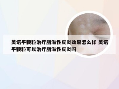 美诺平颗粒治疗脂溢性皮炎效果怎么样 美诺平颗粒可以治疗脂溢性皮炎吗