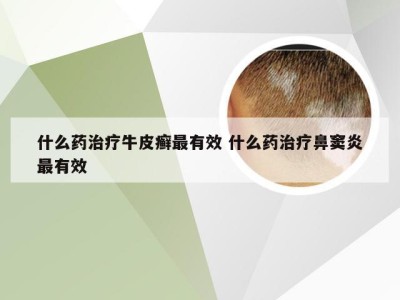 什么药治疗牛皮癣最有效 什么药治疗鼻窦炎最有效