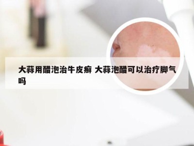 大蒜用醋泡治牛皮癣 大蒜泡醋可以治疗脚气吗