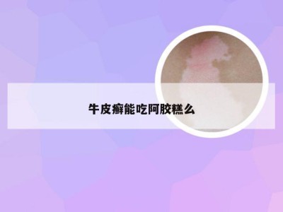 牛皮癣能吃阿胶糕么