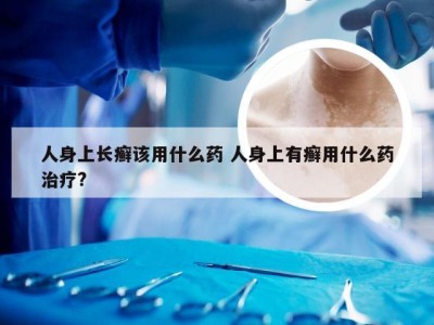 人身上长癣该用什么药 人身上有癣用什么药治疗?