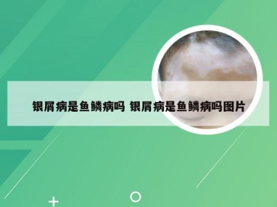 银屑病是鱼鳞病吗 银屑病是鱼鳞病吗图片