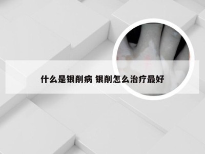 什么是银削病 银削怎么治疗最好