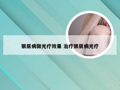 银屑病做光疗效果 治疗银屑病光疗