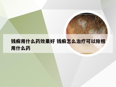 钱癣用什么药效果好 钱癣怎么治疗可以除根用什么药