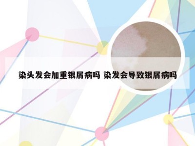 染头发会加重银屑病吗 染发会导致银屑病吗