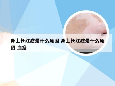 身上长红痣是什么原因 身上长红痣是什么原因 血痣