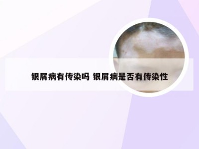 银屑病有传染吗 银屑病是否有传染性