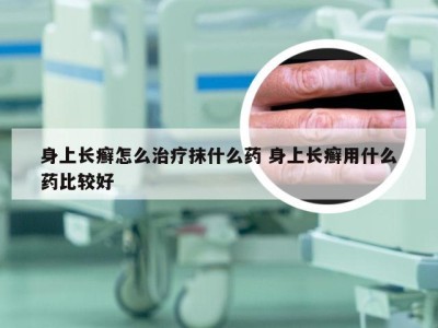 身上长癣怎么治疗抹什么药 身上长癣用什么药比较好