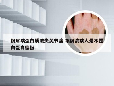 银屑病蛋白质流失关节痛 银屑病病人是不是白蛋白偏低