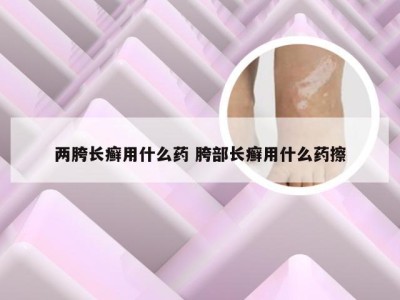 两胯长癣用什么药 胯部长癣用什么药擦