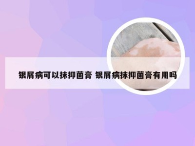 银屑病可以抹抑菌膏 银屑病抹抑菌膏有用吗