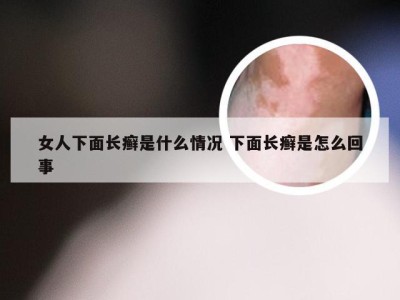 女人下面长癣是什么情况 下面长癣是怎么回事