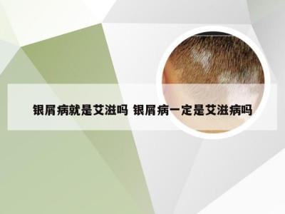 银屑病就是艾滋吗 银屑病一定是艾滋病吗