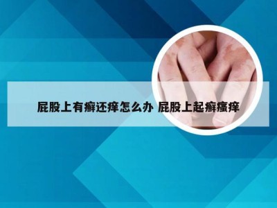 屁股上有癣还痒怎么办 屁股上起癣瘙痒