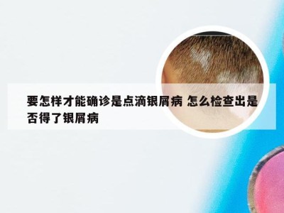 要怎样才能确诊是点滴银屑病 怎么检查出是否得了银屑病