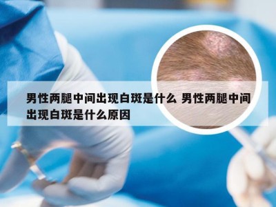 男性两腿中间出现白斑是什么 男性两腿中间出现白斑是什么原因