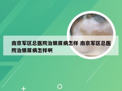 南京军区总医院治银屑病怎样 南京军区总医院治银屑病怎样啊