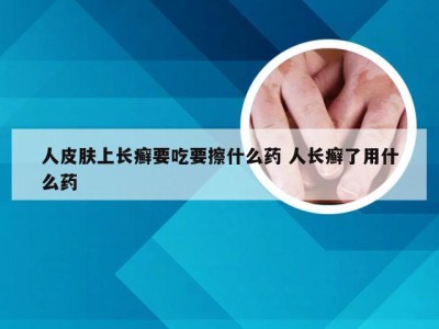 人皮肤上长癣要吃要擦什么药 人长癣了用什么药