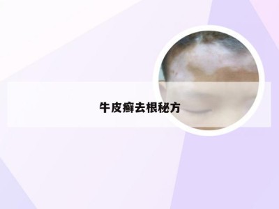 牛皮癣去根秘方