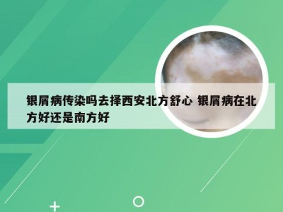 银屑病传染吗去择西安北方舒心 银屑病在北方好还是南方好