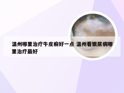 温州哪里治疗牛皮癣好一点 温州看银屑病哪里治疗最好