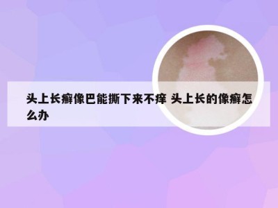 头上长癣像巴能撕下来不痒 头上长的像癣怎么办