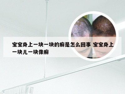 宝宝身上一块一块的癣是怎么回事 宝宝身上一块儿一块像癣