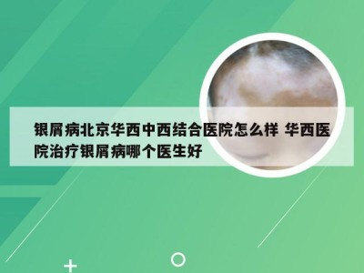 银屑病北京华西中西结合医院怎么样 华西医院治疗银屑病哪个医生好